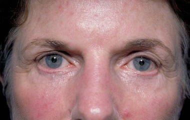 After Image: Eyelid Surgery - front