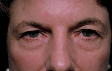 Before Image: Eyelid Surgery - front