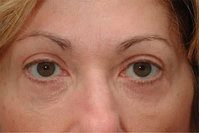 After Image: Eyelid Surgery - front