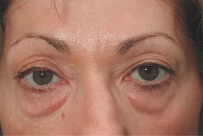 Before Image: Eyelid Surgery - front