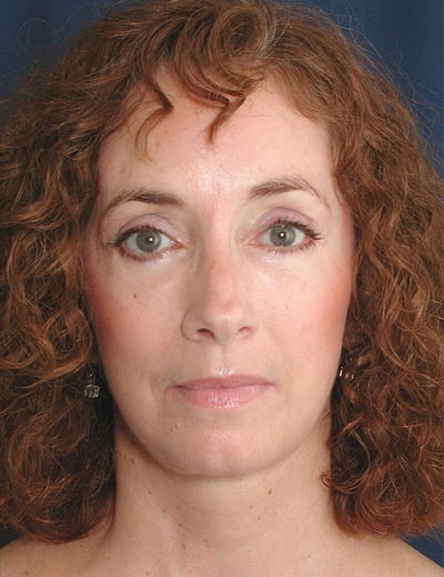 After Image: Eyelid Surgery - front