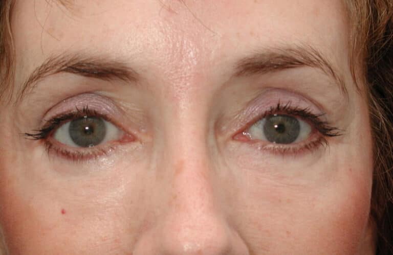 After Image: Eyelid Surgery - front