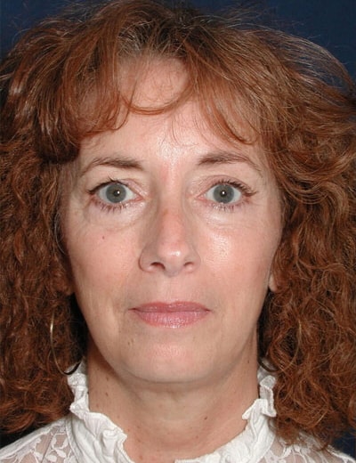 Before Image: Eyelid Surgery - front