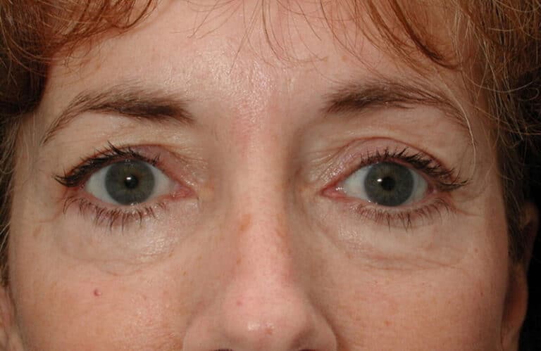 Before Image: Eyelid Surgery - front