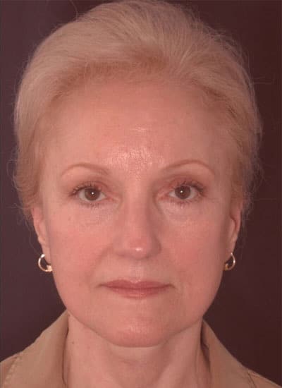 After Image: Eyelid Surgery - front