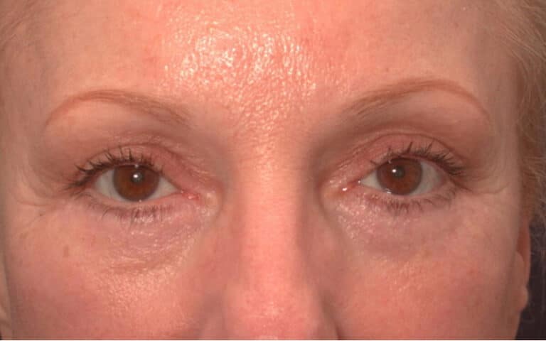 After Image: Eyelid Surgery - front