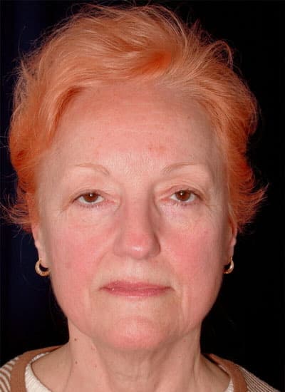 Before Image: Eyelid Surgery - front