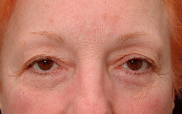 Before Image: Eyelid Surgery - front