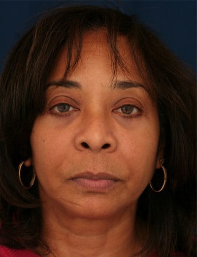 After Image: Eyelid Surgery - front