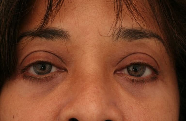 After Image: Eyelid Surgery - front