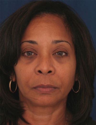 Before Image: Eyelid Surgery - front