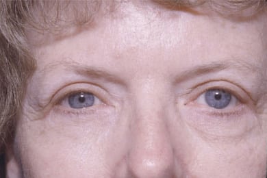 After Image: Eyelid Surgery - front