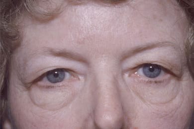 Before Image: Eyelid Surgery - front