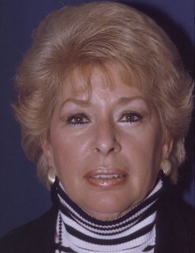 After Image: Eyelid Surgery - front