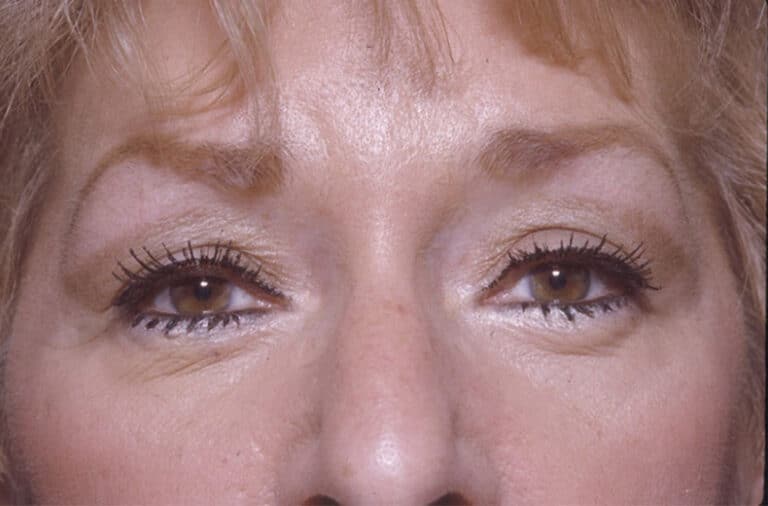 After Image: Eyelid Surgery - front