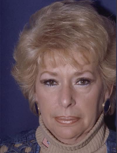 Before Image: Eyelid Surgery - front
