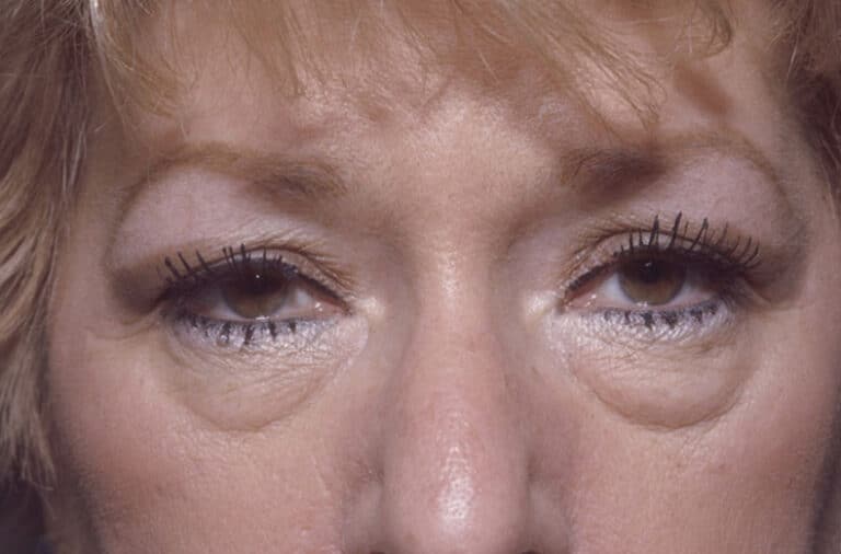 Before Image: Eyelid Surgery - front