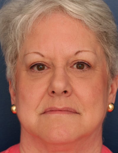 After Image: Eyelid Surgery - front