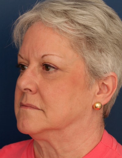 After Image: Eyelid Surgery - left-front-oblique