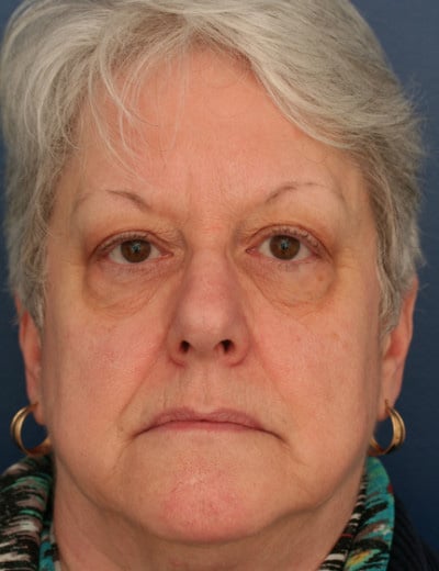 Before Image: Eyelid Surgery - front
