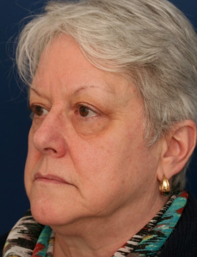 Before Image: Eyelid Surgery - left-front-oblique