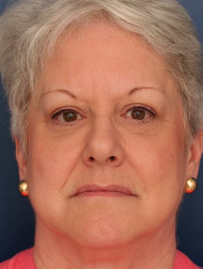 After Image: Eyelid and Facial Fillers - front