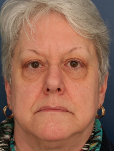 Before Image: Eyelid and Facial Fillers - front
