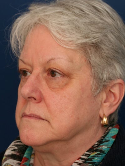 Before Image: Eyelid and Facial Fillers - left-front-oblique
