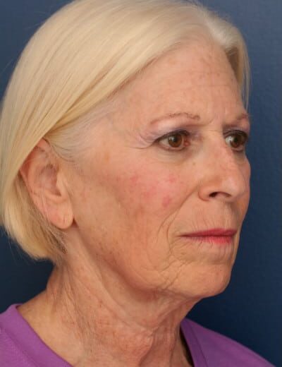 Before Image: Facelift - right-front-oblique