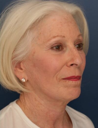 After Image: Facelift - right-front-oblique
