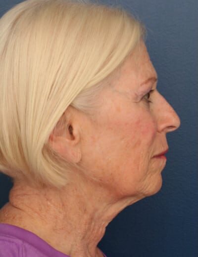 Before Image: Facelift - right-side
