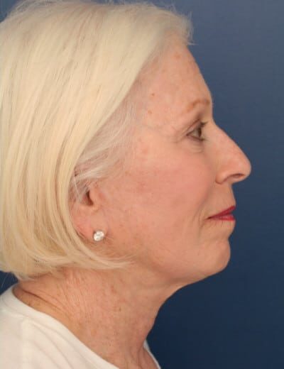 After Image: Facelift - right-side