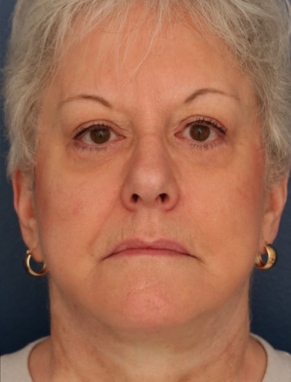 After Image: Facelift - front