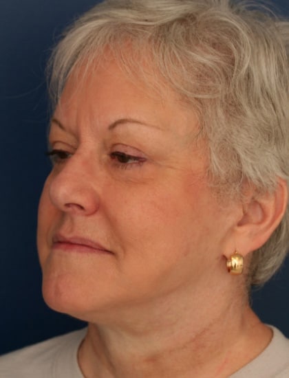 After Image: Facelift - left-front-oblique