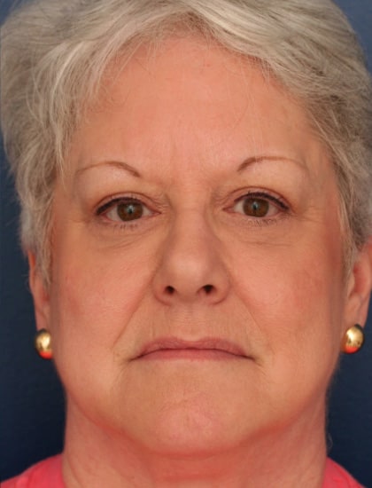 After Image: Facelift - front