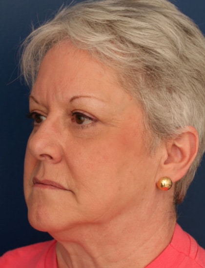 After Image: Facelift - left-front-oblique