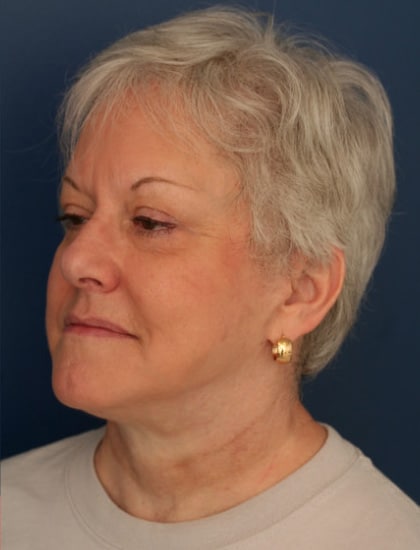 After Image: Facelift - left-front-oblique