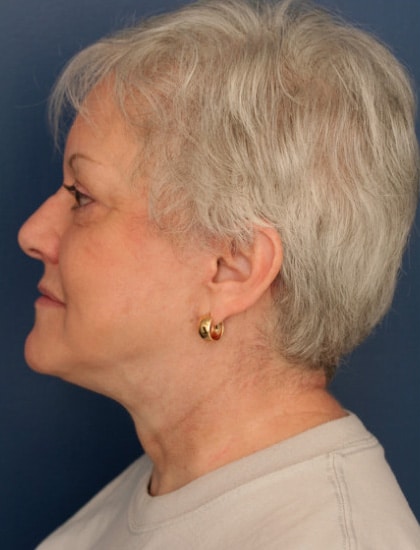 After Image: Facelift - left-side