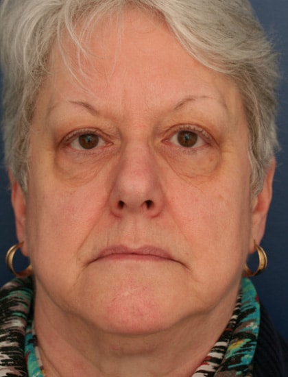 Before Image: Facelift - front