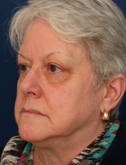 Before Image: Facelift - left-front-oblique