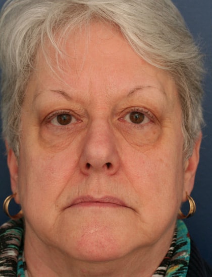 Before Image: Facelift - front