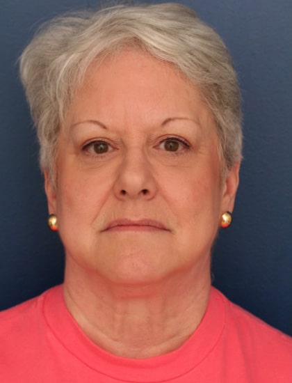 Before Image: Facelift - front