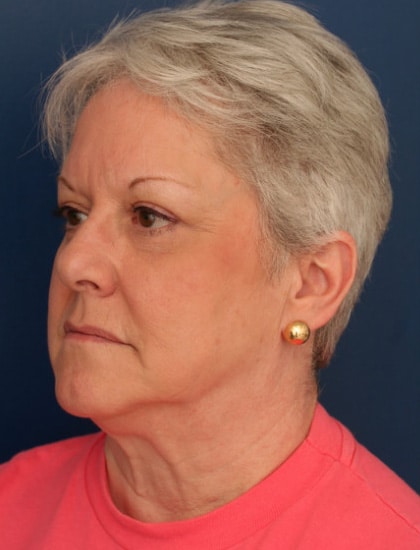 Before Image: Facelift - left-front-oblique
