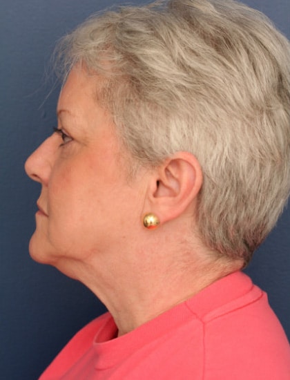 Before Image: Facelift - left-side