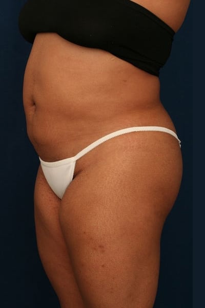 After Image: Fat Grafting - left-front-oblique