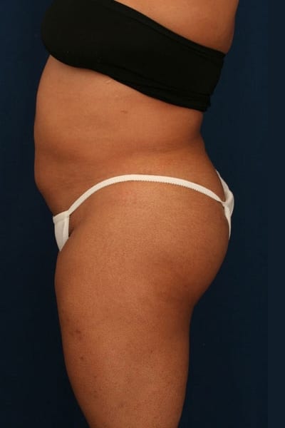 After Image: Fat Grafting - left-side
