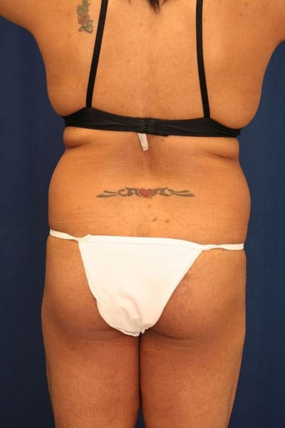 Before Image: Fat Grafting - back