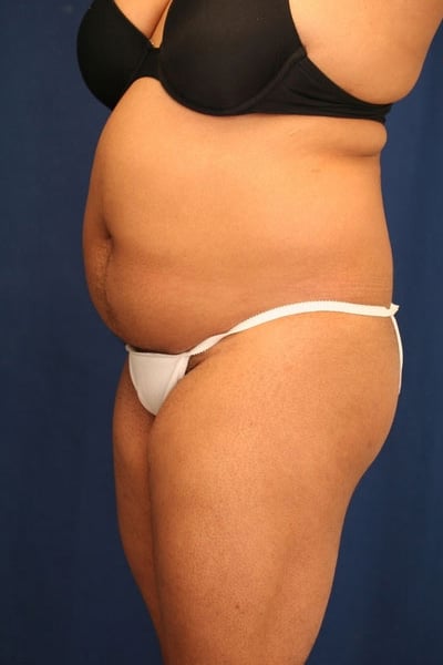 Before Image: Fat Grafting - left-front-oblique