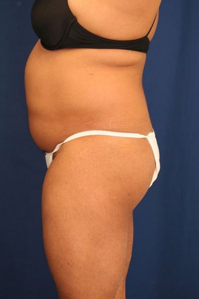 Before Image: Fat Grafting - left-side