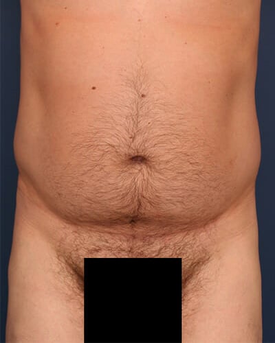 Before Image: Fat Grafting - front